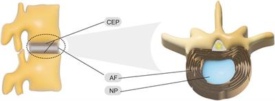 New Hope for Treating Intervertebral Disc Degeneration: Microsphere-Based Delivery System